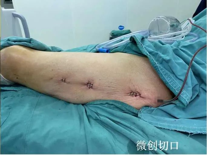 【绥宁县中医医院】骨伤科成功为一95岁高龄患者实施微创手术_邵阳头条网